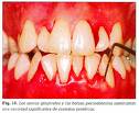 EFECTIVIDAD DEL TRATAMIENTO PERIODONTAL CONVENCIONAL CON O SIN TERAPIA ANTIBI&Oacute;TICA CON AMOXICILINA / METRONIDAZOL EN PACIENTES CON PERIODONTITIS CR&Oacute;NICA